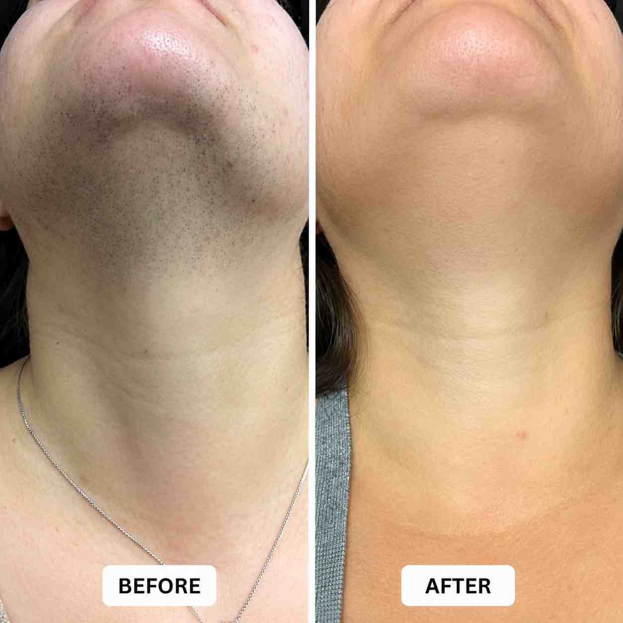 Laser Hair Reduction - After 6 Sessions